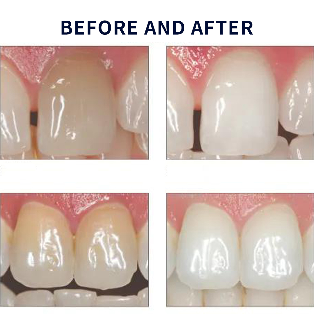 Opalescence Whitening 20% PF 2 – Teeth Whitening In Office recenzja i cena